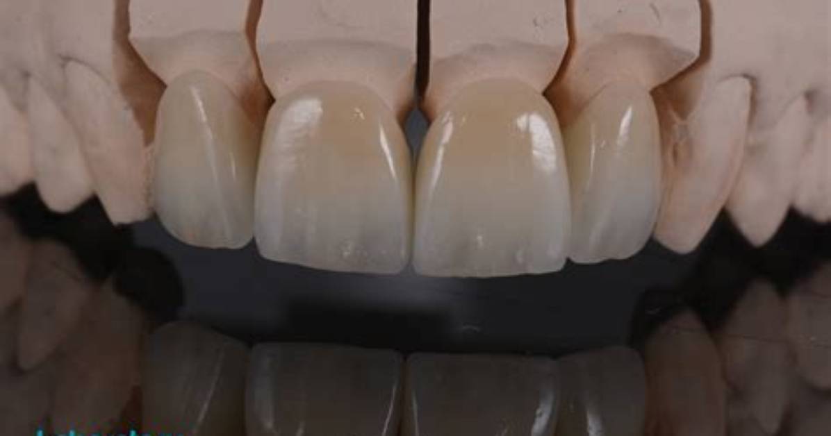 Is Lithium Disilicate a Ceramic?