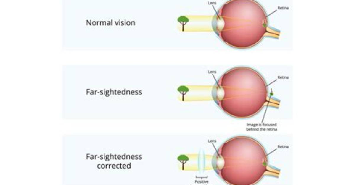 Is Long Sightedness Hereditary?