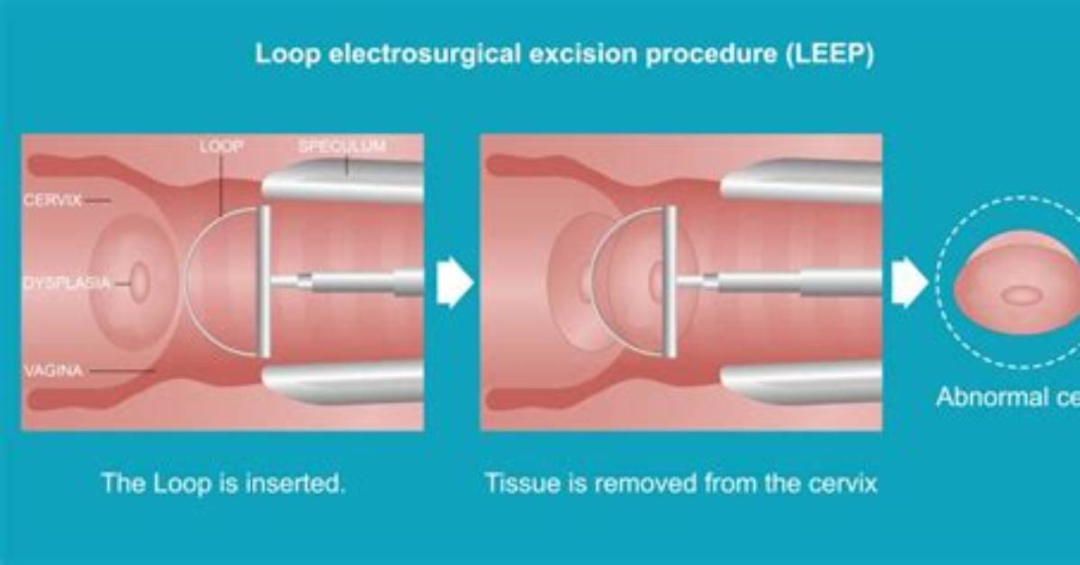 Is Loop Electrosurgical Excision Procedure Expensive?