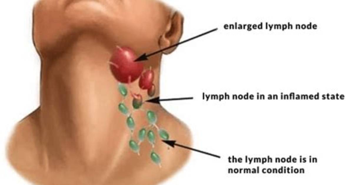 Is Lymph Nodes Dangerous?