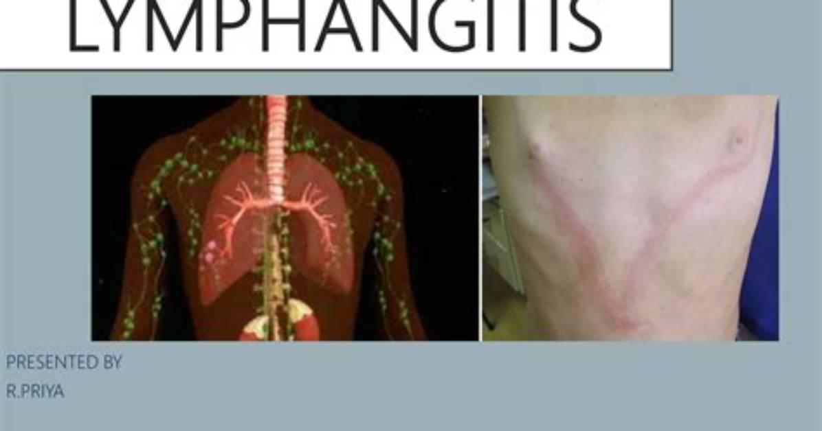 Is Lymphangitis Life Threatening?