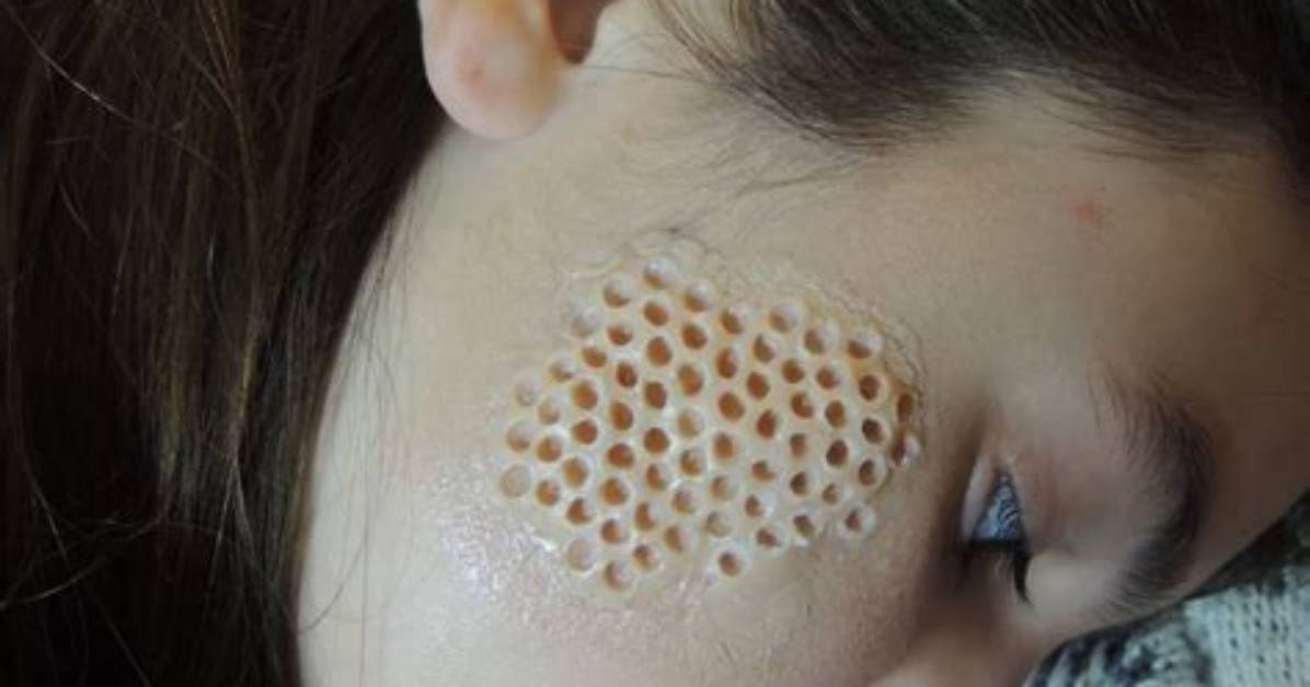 Is Maggot Infested Skin Real?