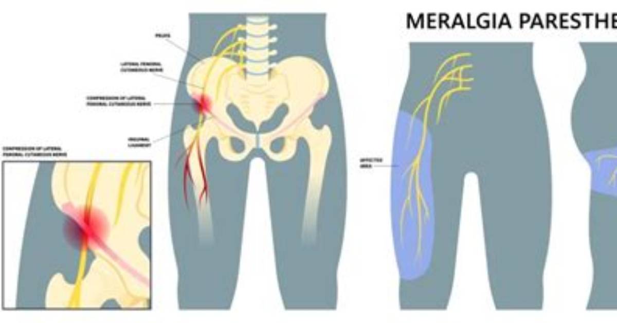 Is Meralgia Paresthetica Common?