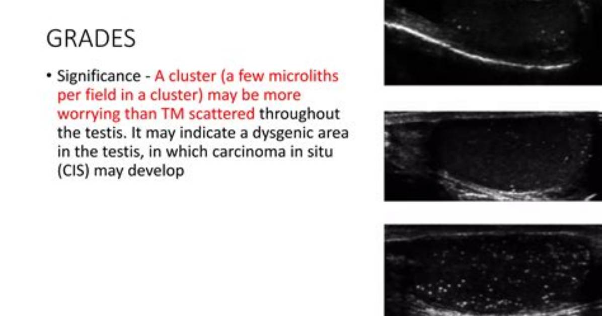 Is Microlithiasis Painful