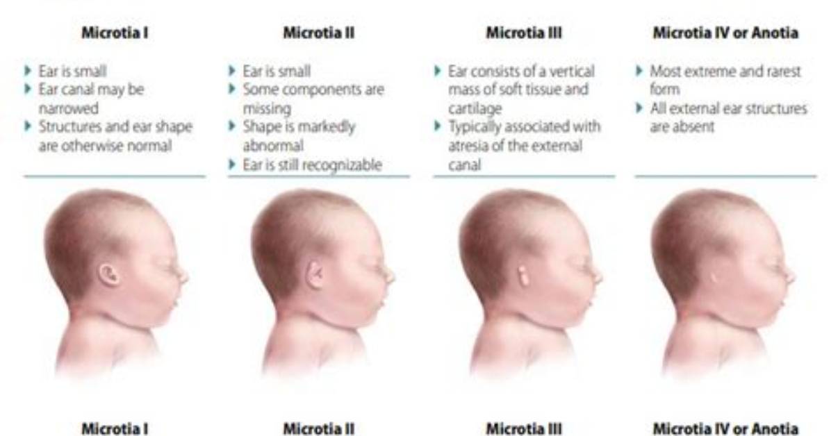 Is Microtia Considered a Disability?