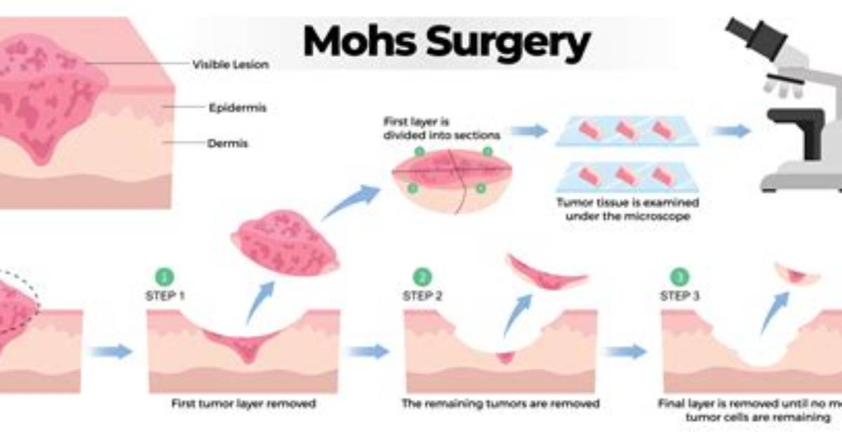 Is Mohs Surgery Disfiguring?