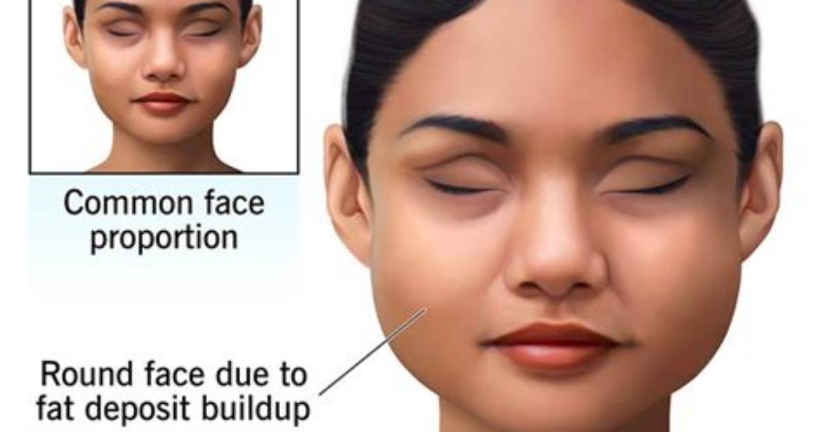 Is Moon Face Real?