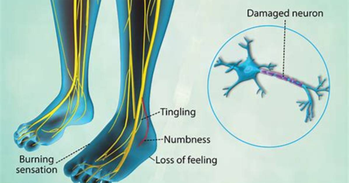 Is Nerve Damage Serious?