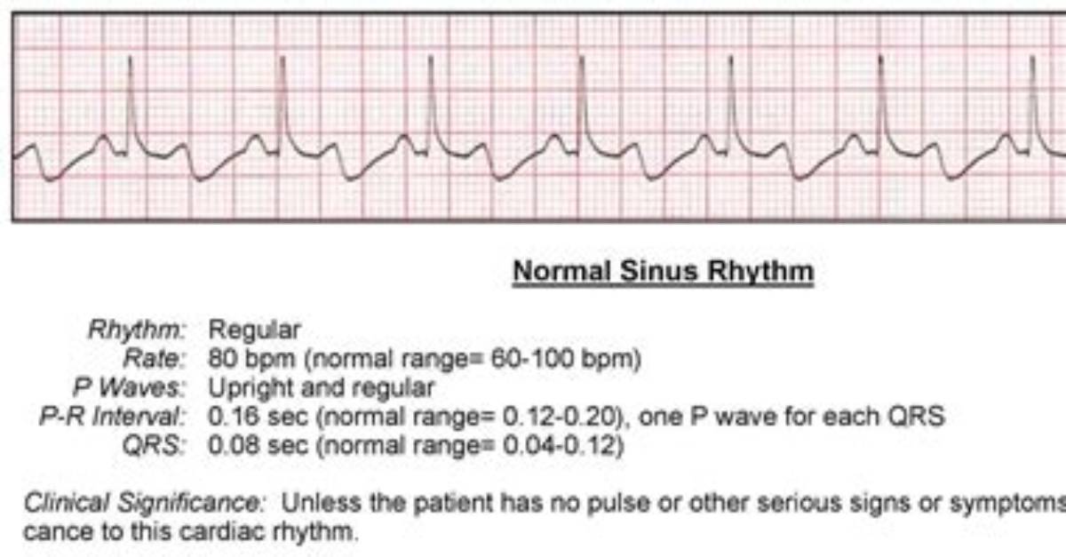 Is Normal Sinus Rhythm Good