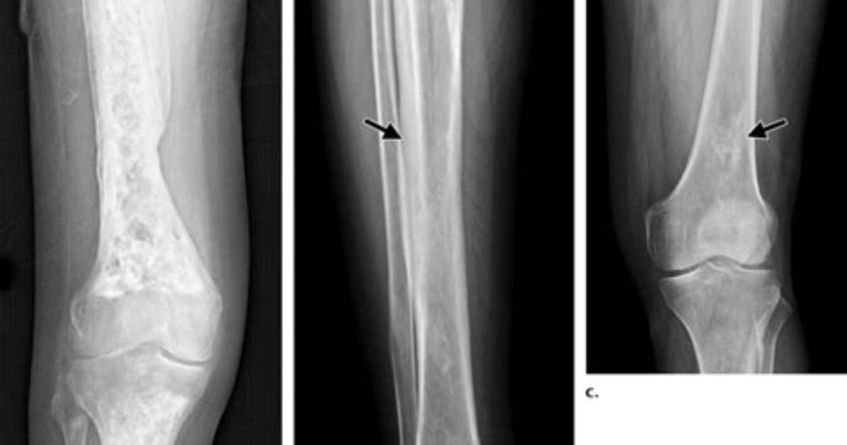 Is Osteosclerosis a Word?