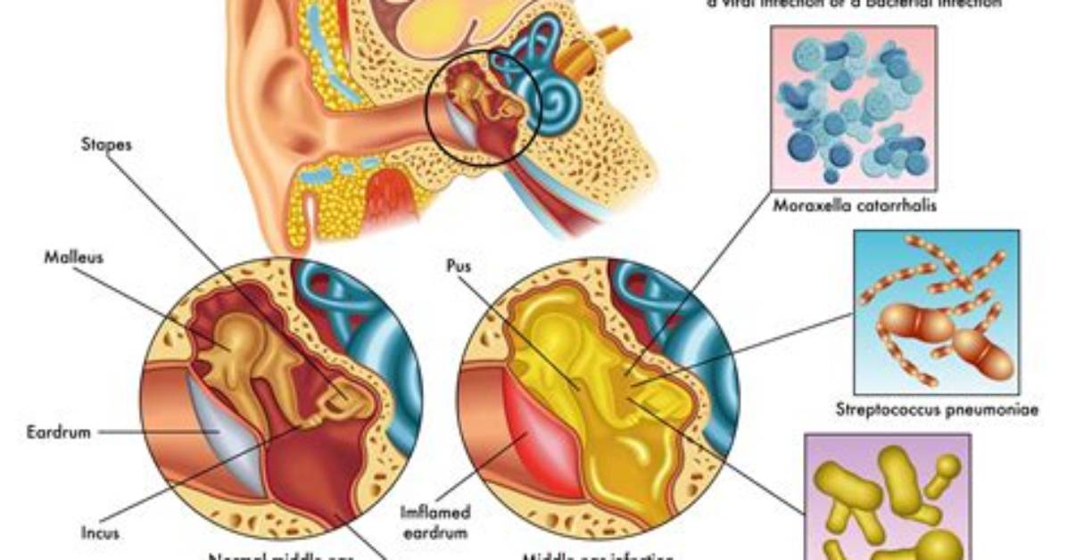 Is Otitis Media Serous?