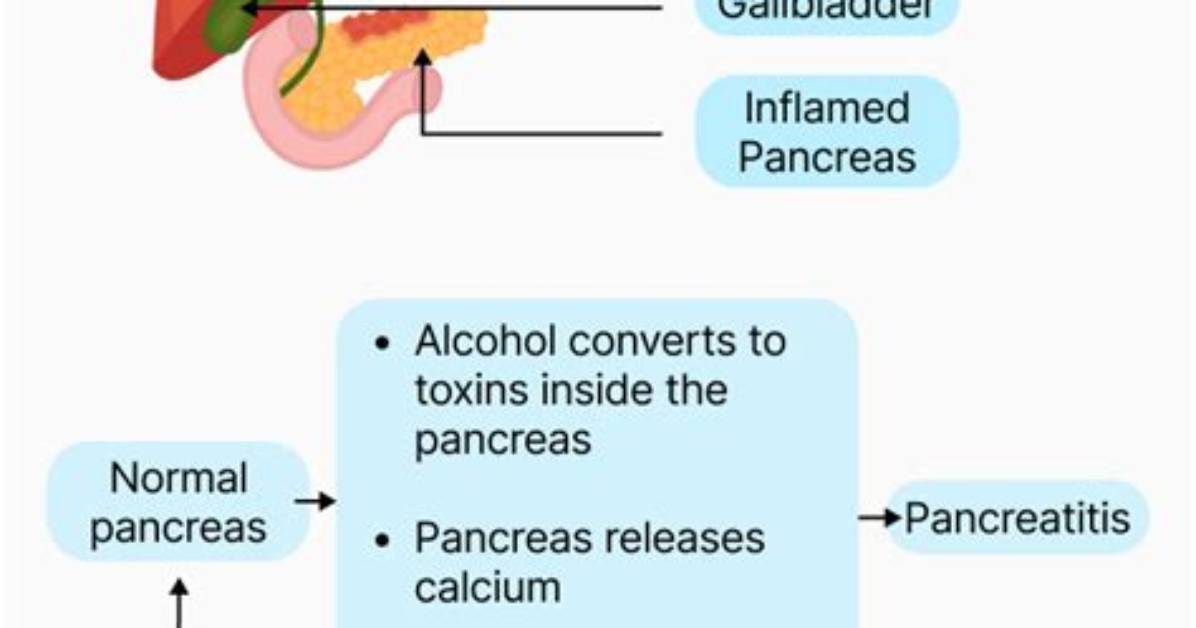 Is Pancreatitis Caused by Drinking?