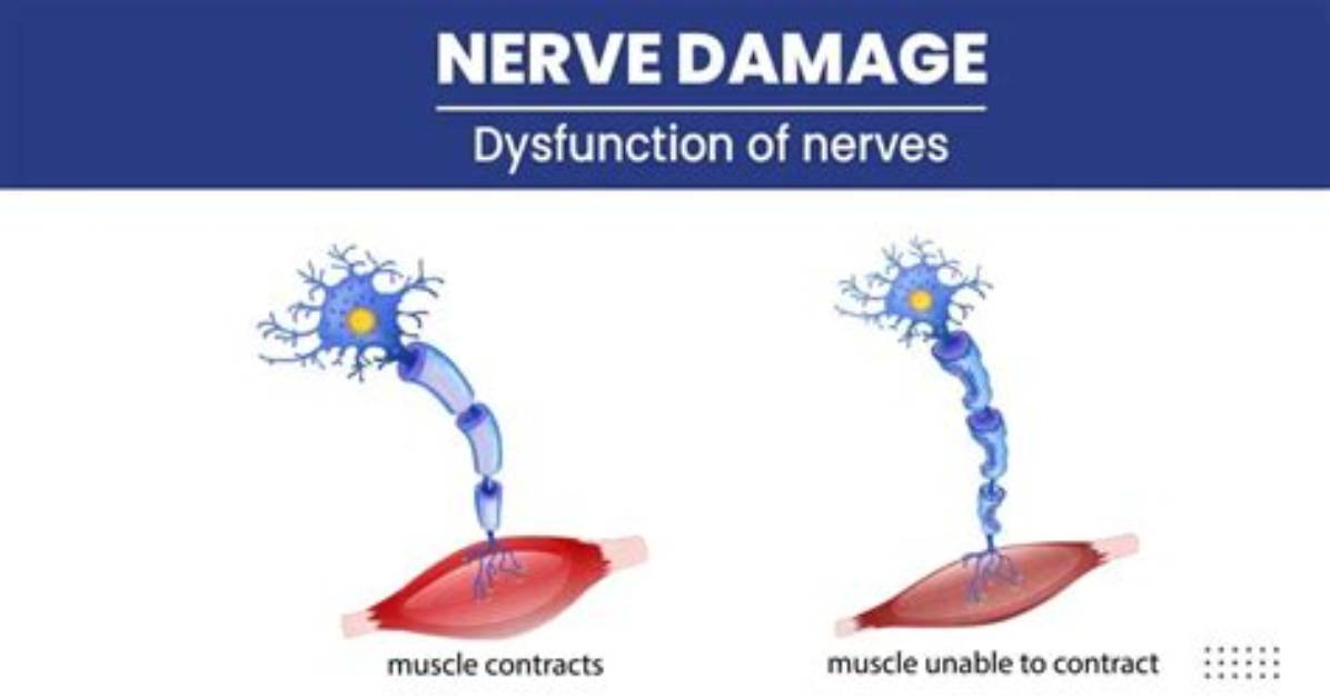 Is Pinched Nerve Damage Permanent?