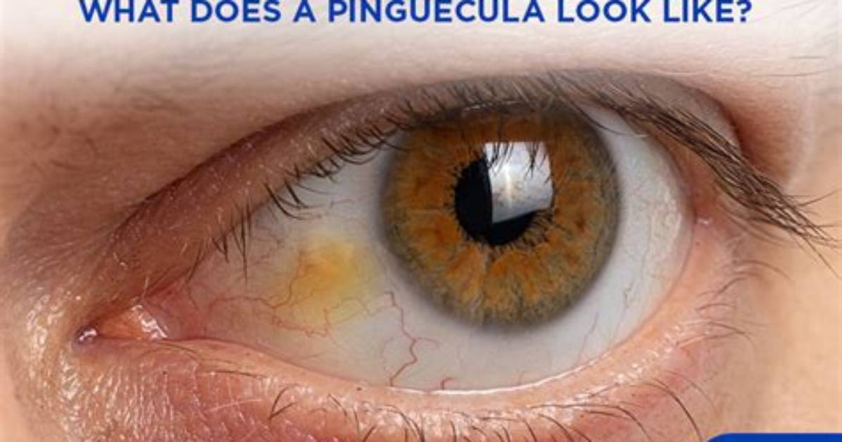 Is Pinguecula Contagious