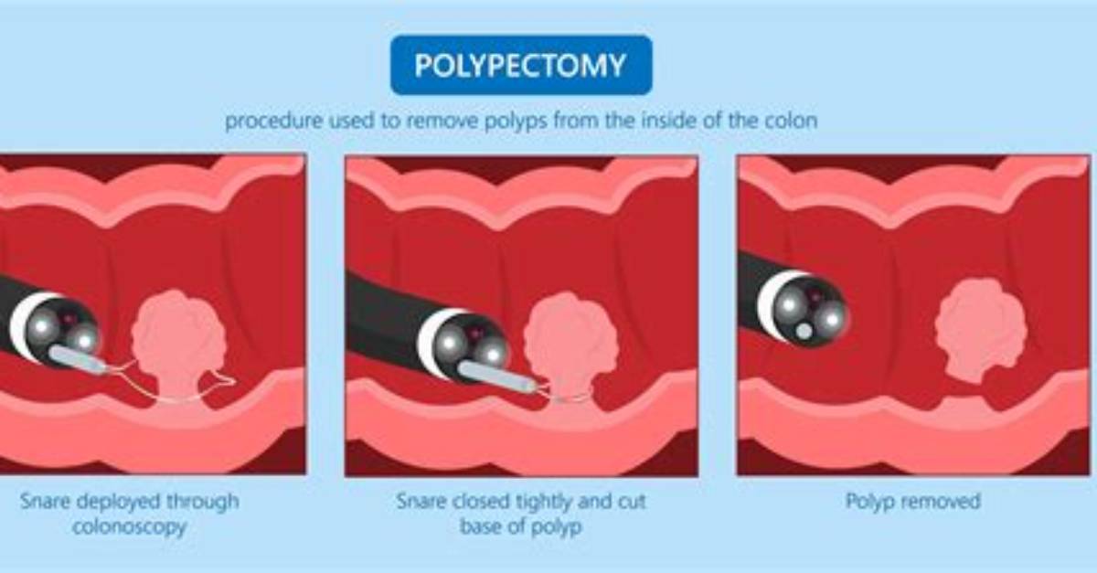 Is Polypectomy Serious
