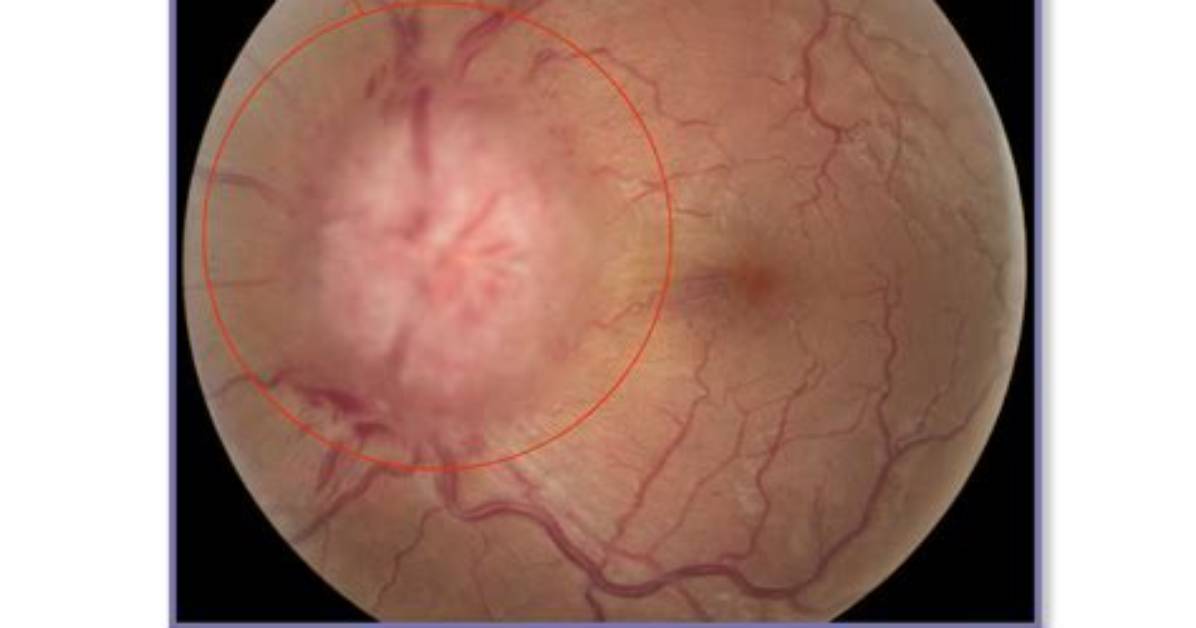Is Pseudotumor Cerebri Serious?
