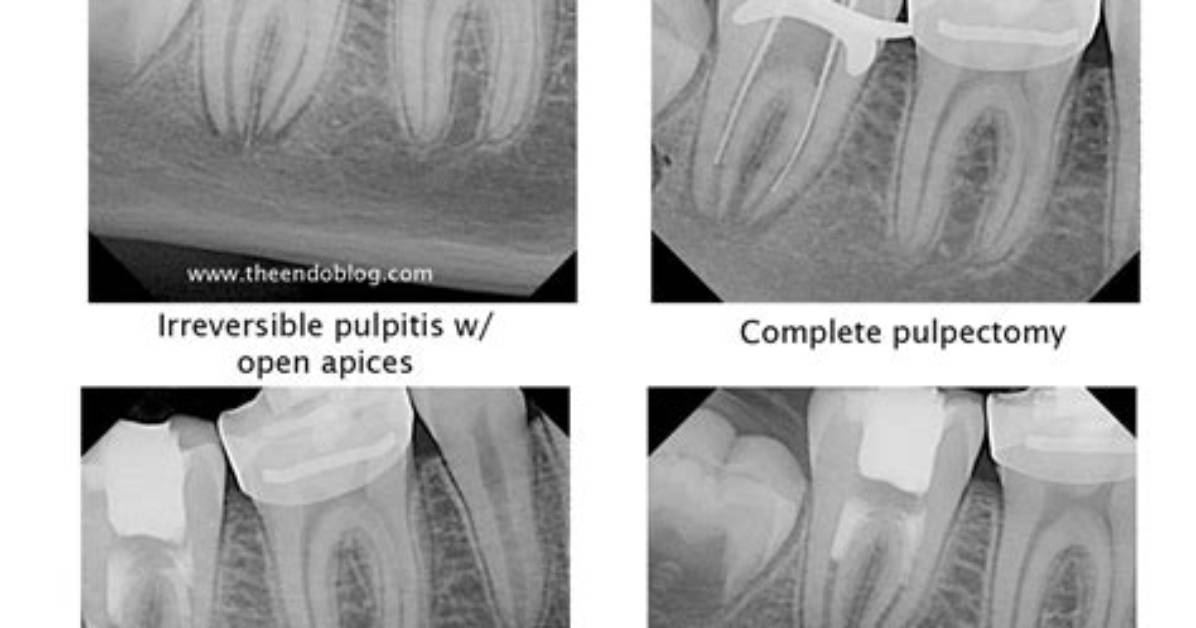 Is Pulpitis Visible on X Ray?