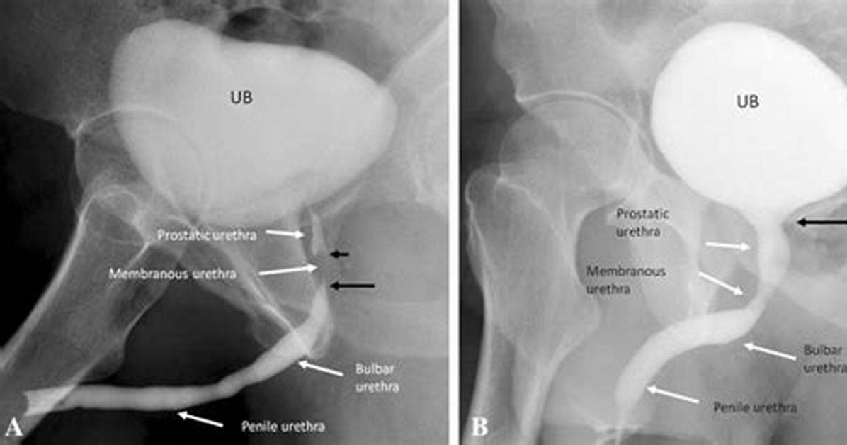 Is Retrograde Urethrogram Painful?