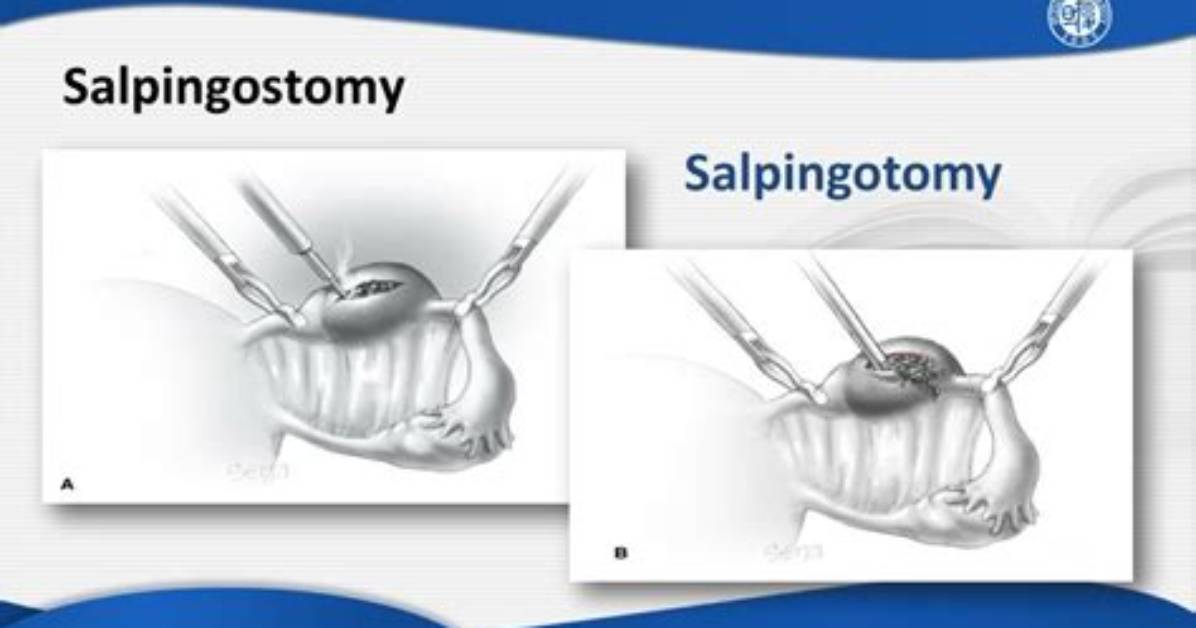 Is Salpingostomy and Salpingotomy the Same?