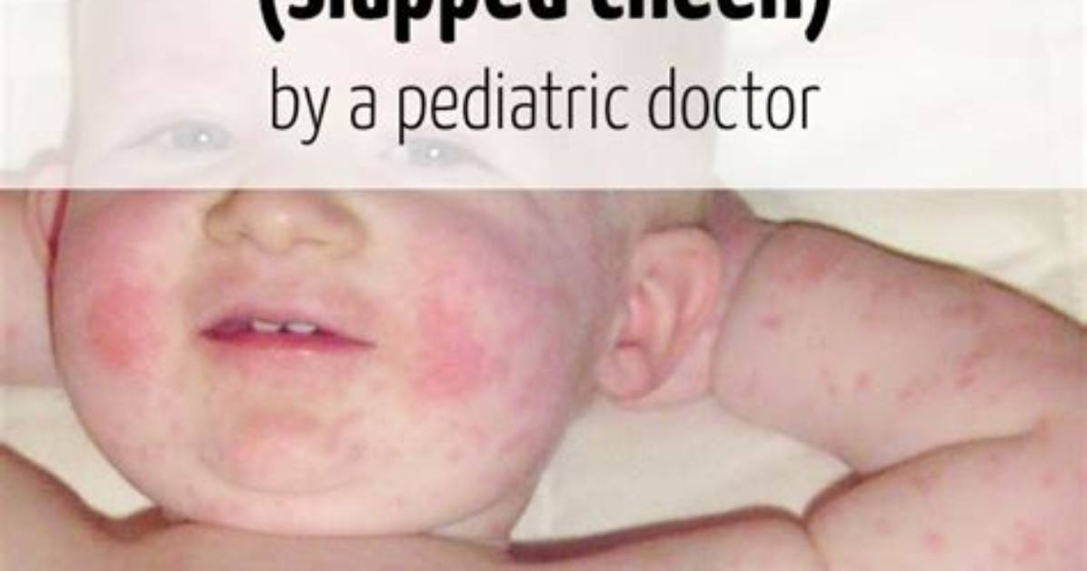 Is Slap Cheek a Virus?