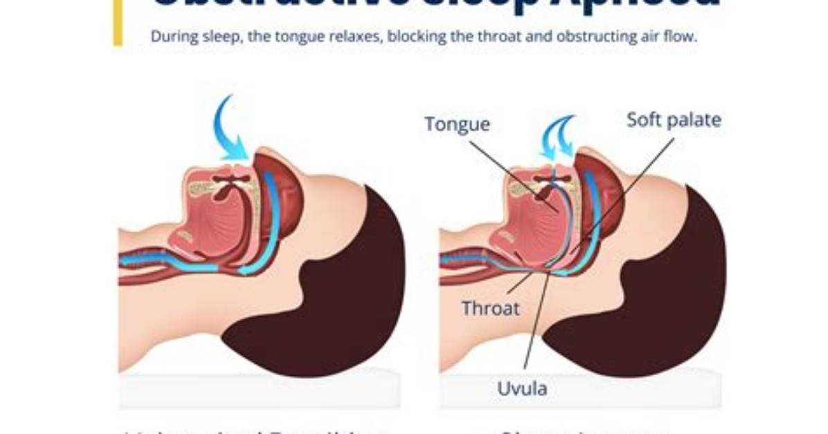 Is Sleep Apnoea a Disability?