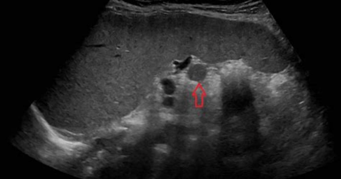 Is Splenule Normal