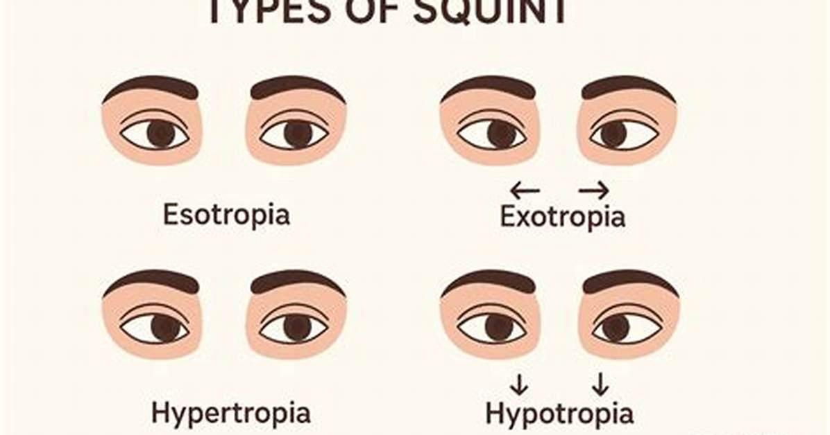 Is Squint Eye Curable?
