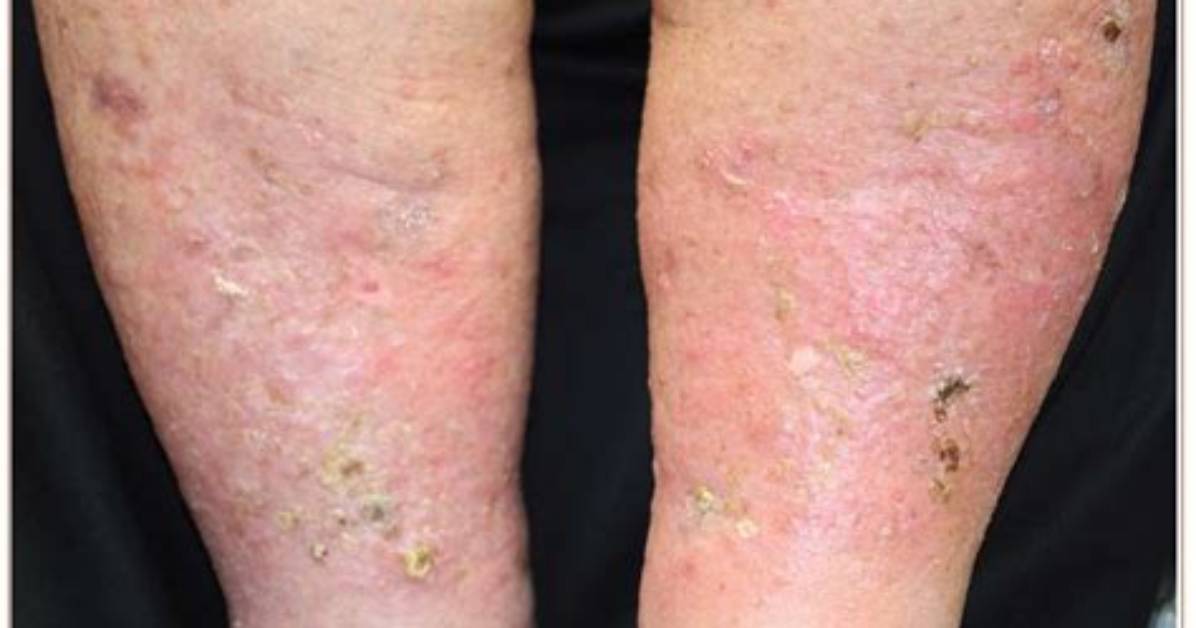 Is Stasis Dermatitis Dangerous?