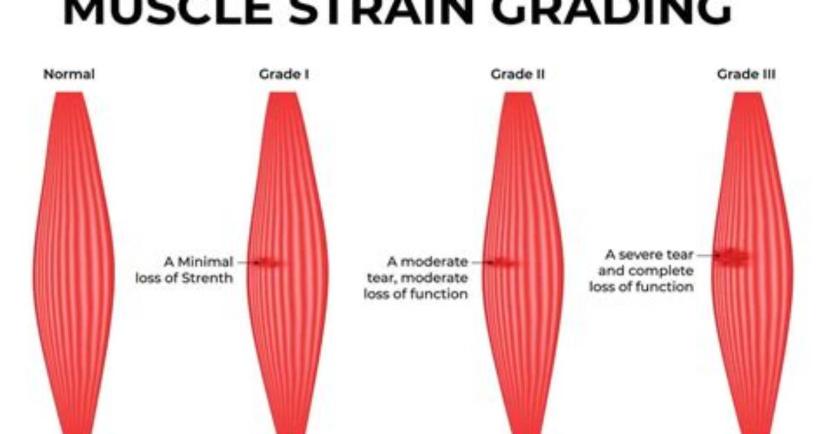 Is Strain a Muscle?