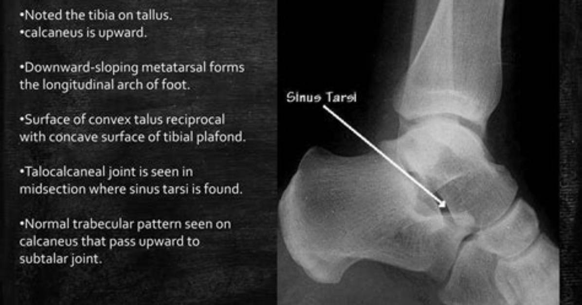 Is Talus Concave or Convex