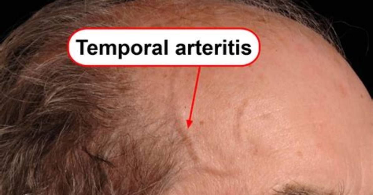 Is Temporal Arteritis Serious