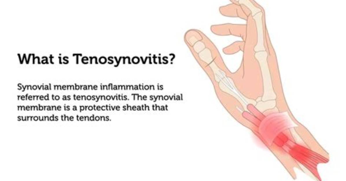 Is Tendonitis the Same as Tenosynovitis