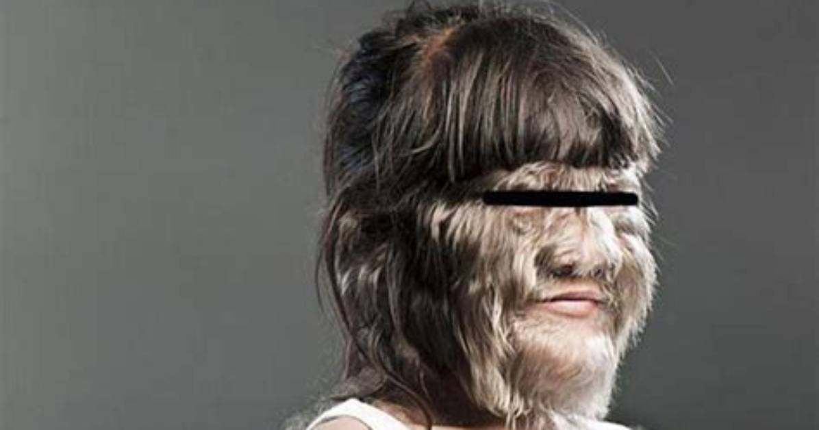 Is There a Cure for Hypertrichosis?