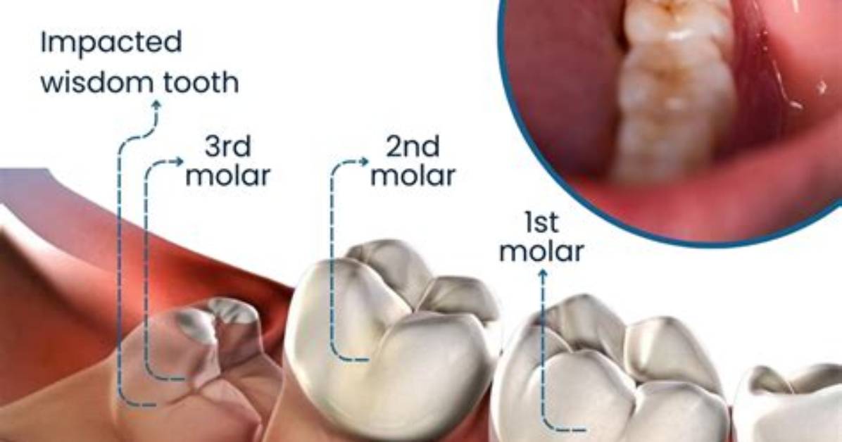 Is Throbbing Normal After Wisdom Teeth Removal?