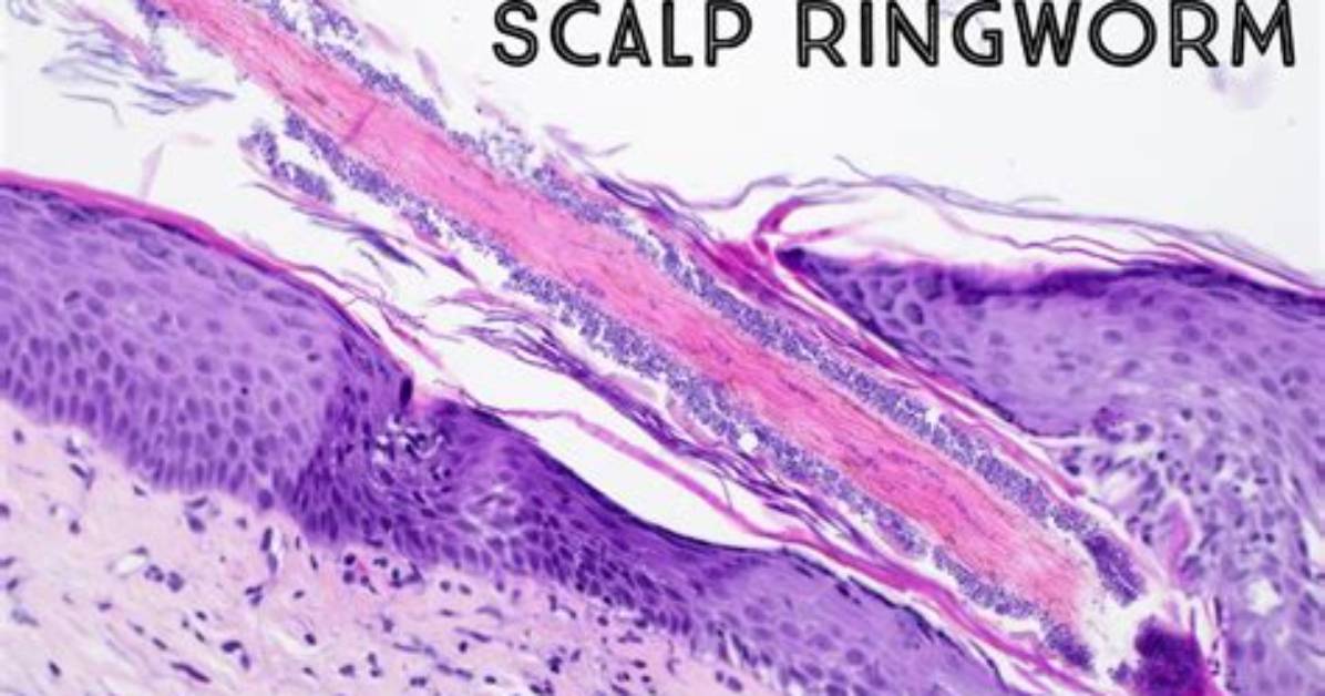 Is Tinea Capitis a Parasite