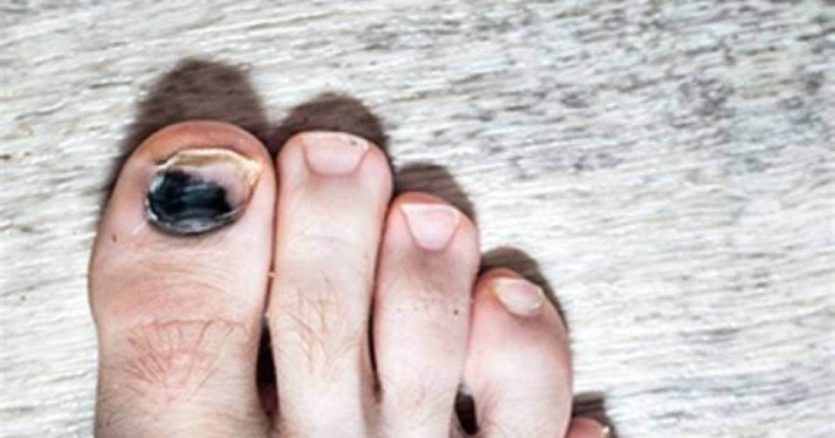 Is Toenail Fungus Black?