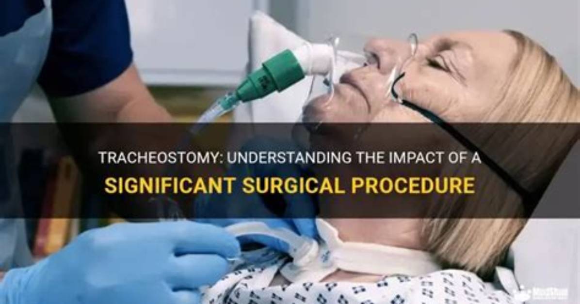 Is Tracheostomy a Major Surgery