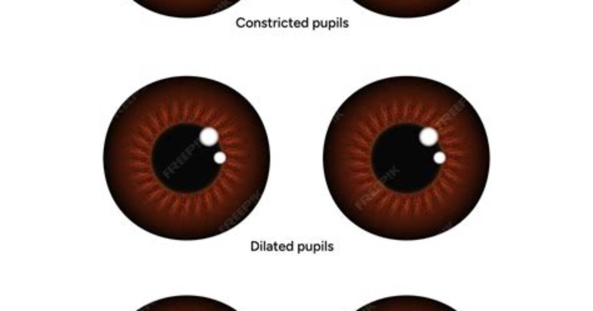 Is Unequal Pupils Normal