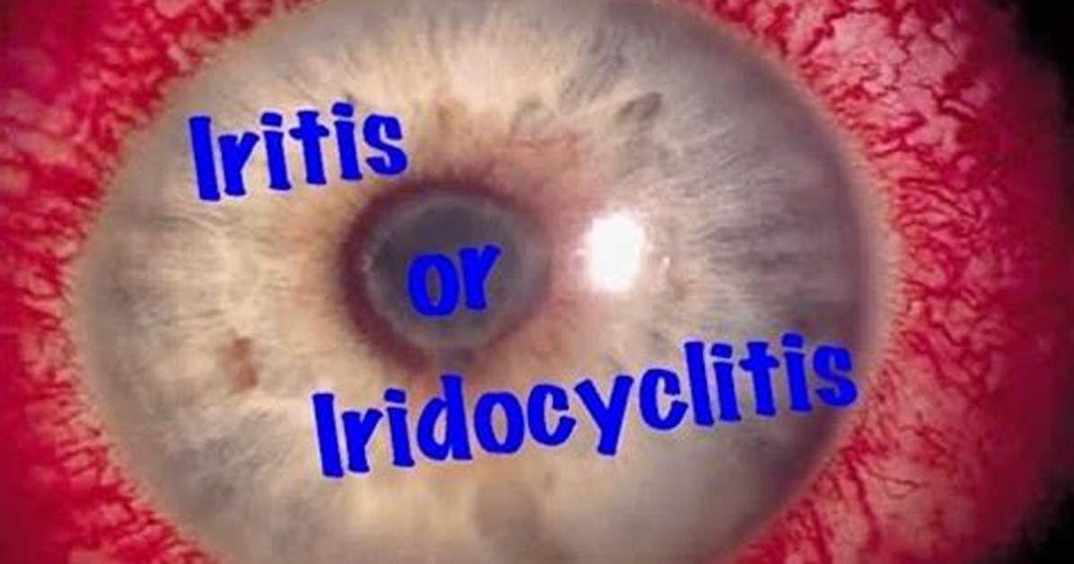 Is Uveitis the Same as Iridocyclitis?