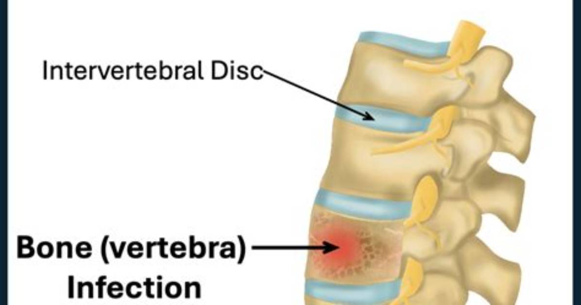 Is Vertebral Osteomyelitis Contagious?