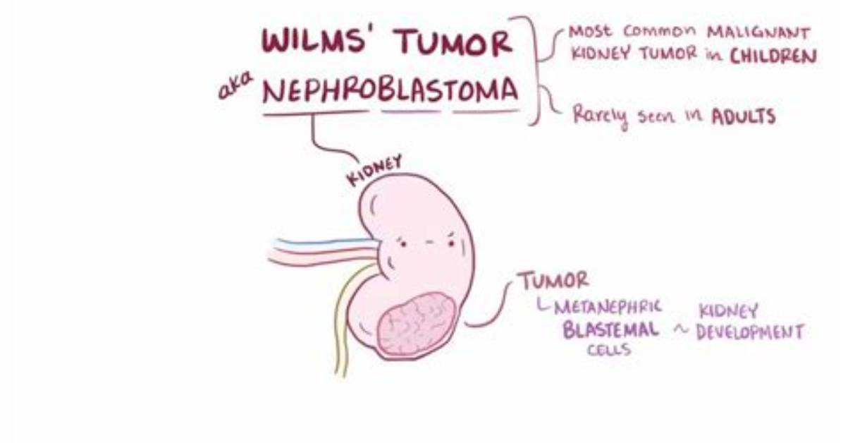 Is Wilms Tumor Malignant