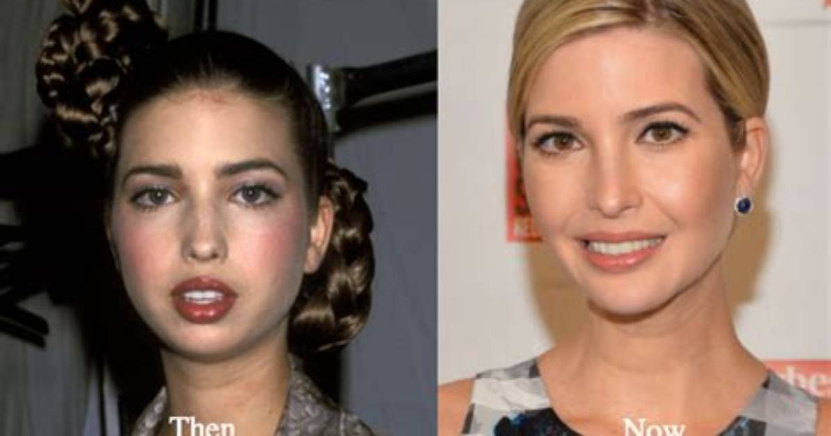 Ivanka Trump’s Plastic Surgery — Her Before and After Photos