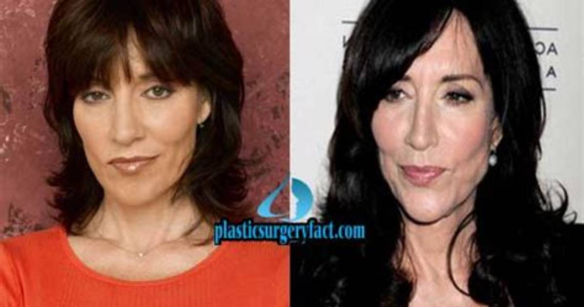 Katey Sagal Facelift Plastic Surgery Before and After