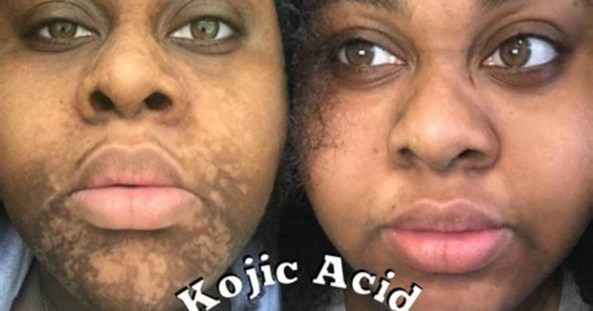 Kojic Acid Soap Side Effects