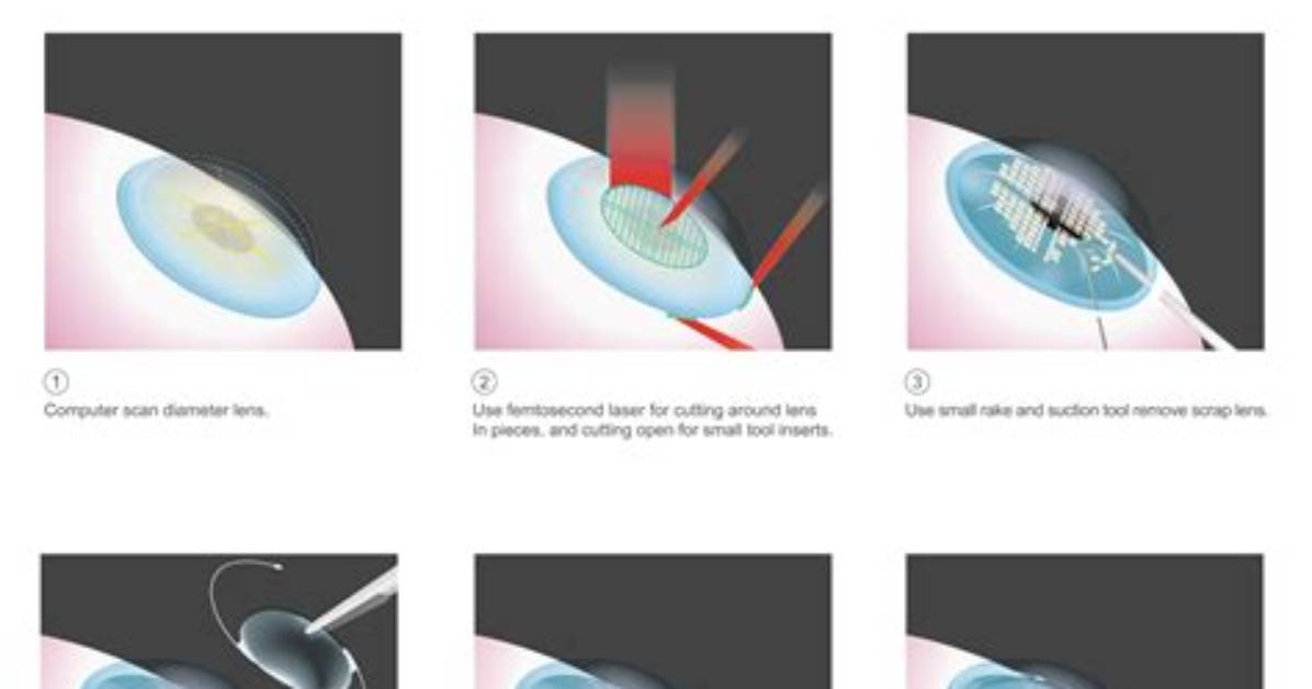 Laser Surgery for Cataracts