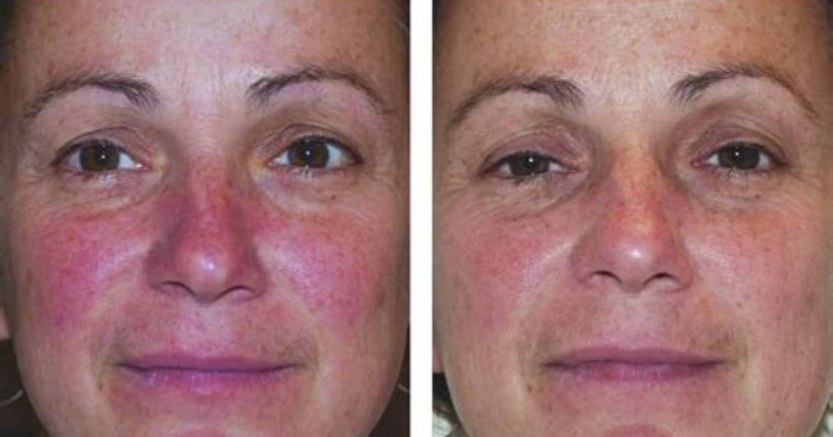 Led Light Therapy Before and After