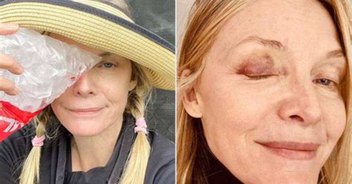Michelle Pfeiffer Has Black Eye from Pickleball