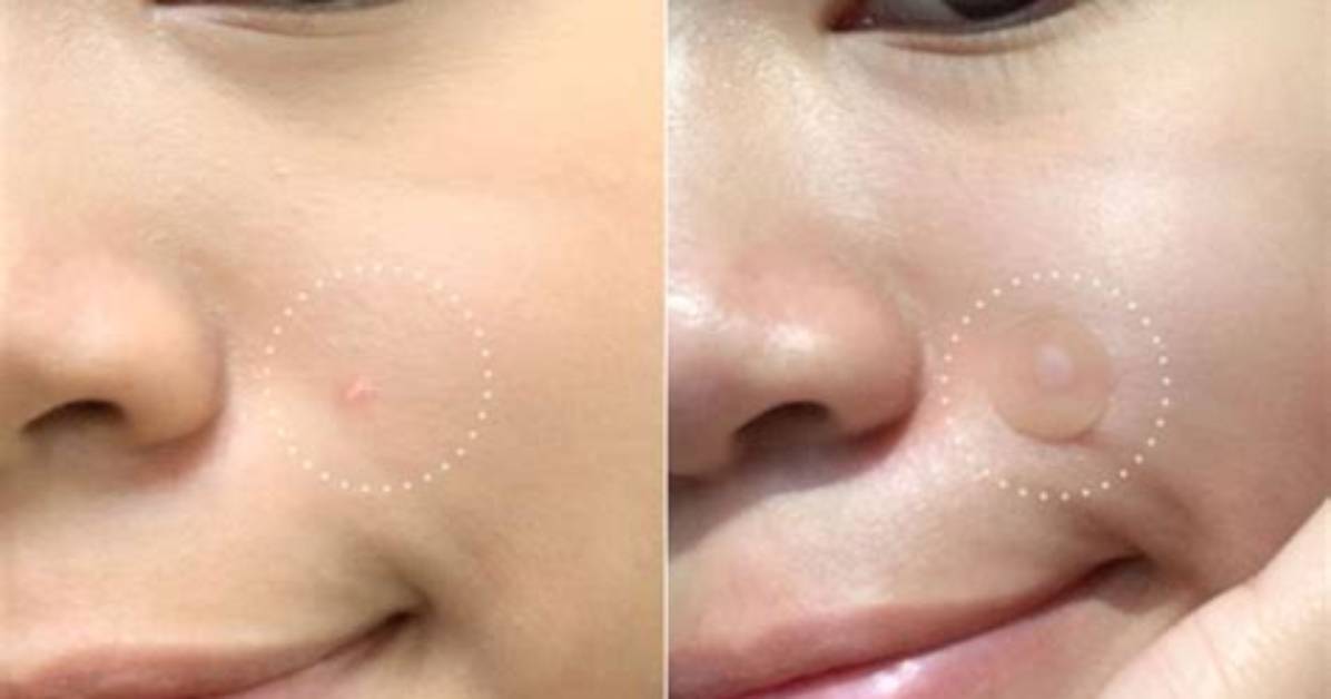 Mighty Patch Before and After