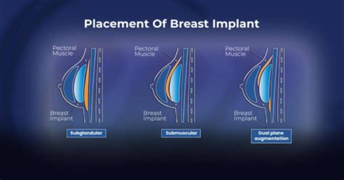Model's Breast Implants Prove Key to Identifying Body