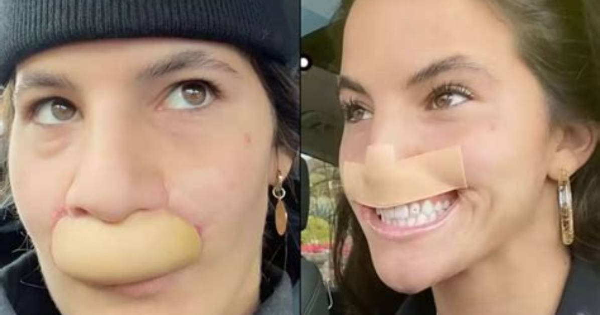 Model Whose Lip Was Bitten off by Dog Shows off Transformation After Six Surgeries